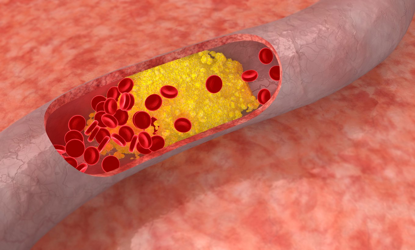 A cholesterol plaque in an artery