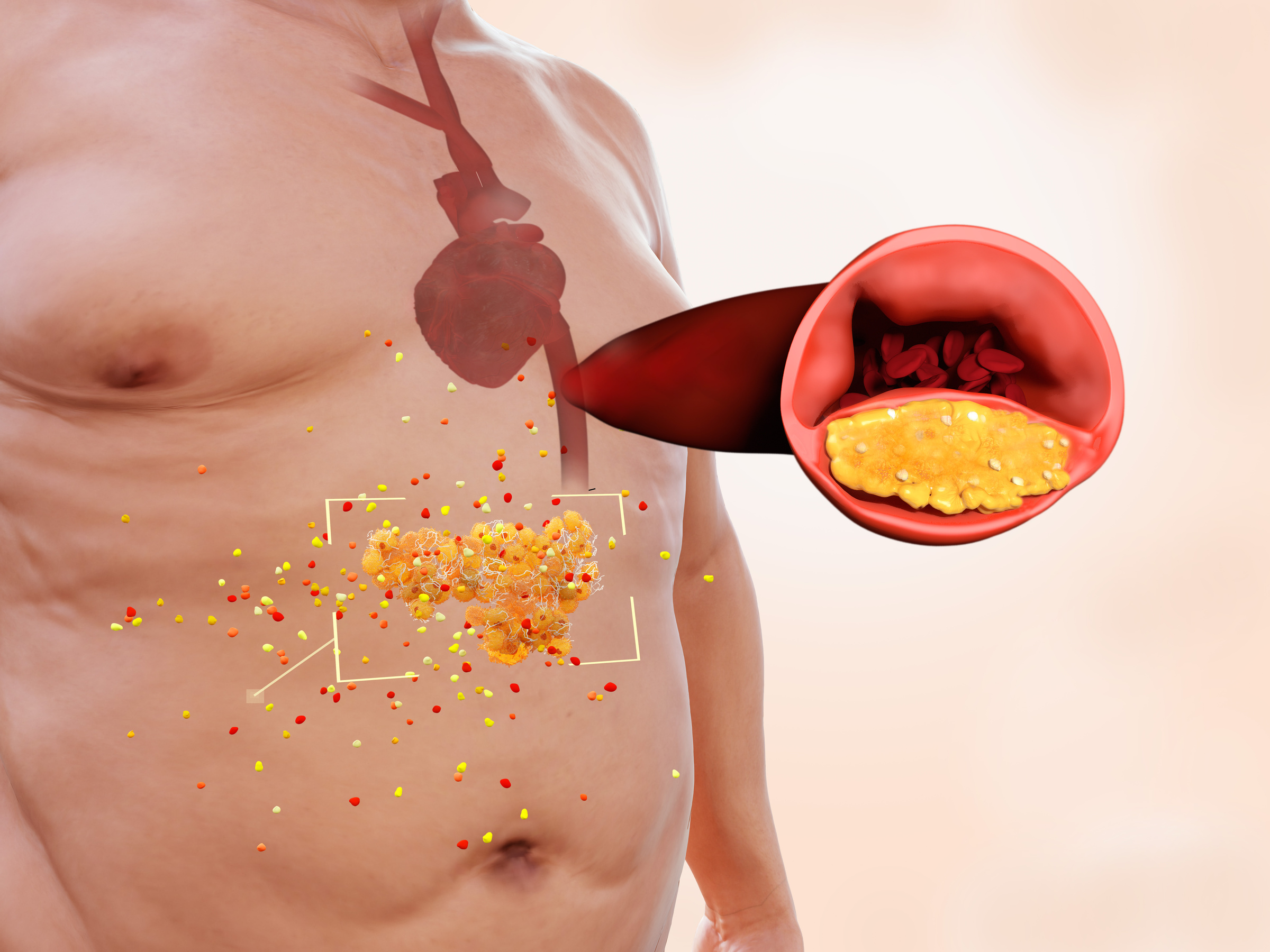 Visceral fat increases the risk of atherosclerosis and stroke. 3d rendering