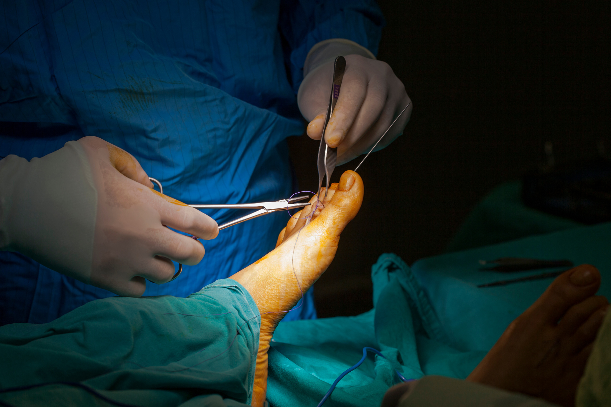 Human Foot Surgery